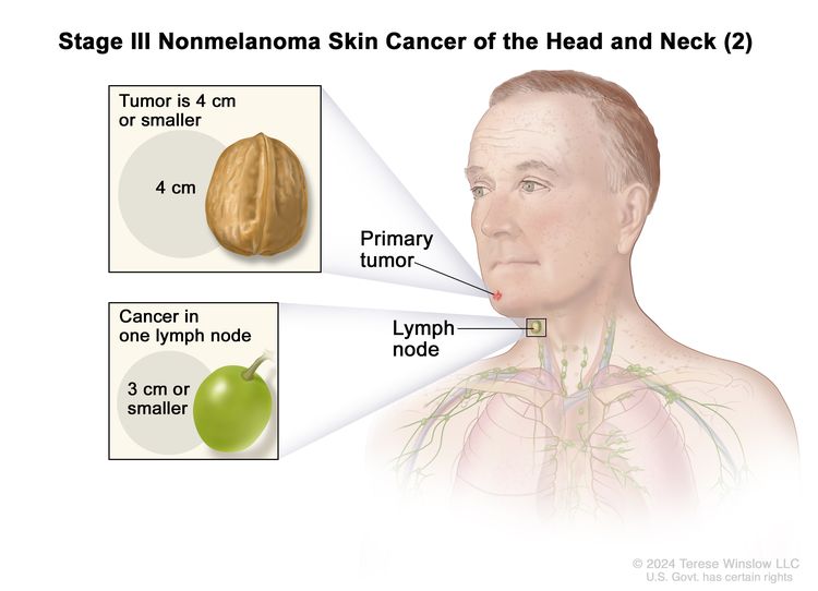 Stage III nonmelanoma skin cancer of the head and neck (2); drawing shows a primary tumor on the face and cancer in one lymph node on the same side of the body as the tumor. The top inset shows that the tumor is 4 centimeters or smaller and that 4 centimeters is about the size of a walnut. The bottom inset shows that the lymph node with cancer is 3 centimeters or smaller and that 3 centimeters is about the size of a grape.