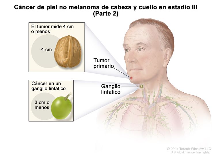 Cáncer de piel no melanoma de cabeza y cuello en estadio III (Parte 2). En el dibujo se observa una persona con un tumor primario en el mentón y cáncer en un ganglio linfático del cuello al mismo lado del cuerpo que el tumor. A la izquierda se muestran dos recuadros. En el recuadro superior, se indica que el tumor primario mide 4 cm o menos, que es casi el tamaño de una nuez. En el recuadro inferior, se señala que el cáncer en el ganglio linfático mide 3 cm o menos, que es casi el tamaño de una uva.