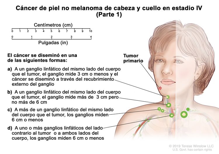 Cáncer de piel no melanoma de cabeza y cuello en estadio IV (Parte 1). En la imagen se observa un tumor primario en la cara y cáncer que se diseminó en una de las siguientes formas: a) a un ganglio linfático del mismo lado del cuerpo que el tumor, el ganglio mide 3 cm o menos y el cáncer se diseminó a través del recubrimiento externo del ganglio linfático; b) a un ganglio linfático del mismo lado del cuerpo que el tumor, el ganglio mide más de 3 cm pero no más de 6 cm; c) a más de un ganglio linfático del mismo lado del cuerpo que el tumor, los ganglios miden 6 cm o menos; y d) uno o más ganglios linfáticos del lado del cuerpo contrario al tumor o a ambos lados del cuerpo, los ganglios miden 6 cm o menos. También se observan una regla de 10 cm y una regla de 4 in.