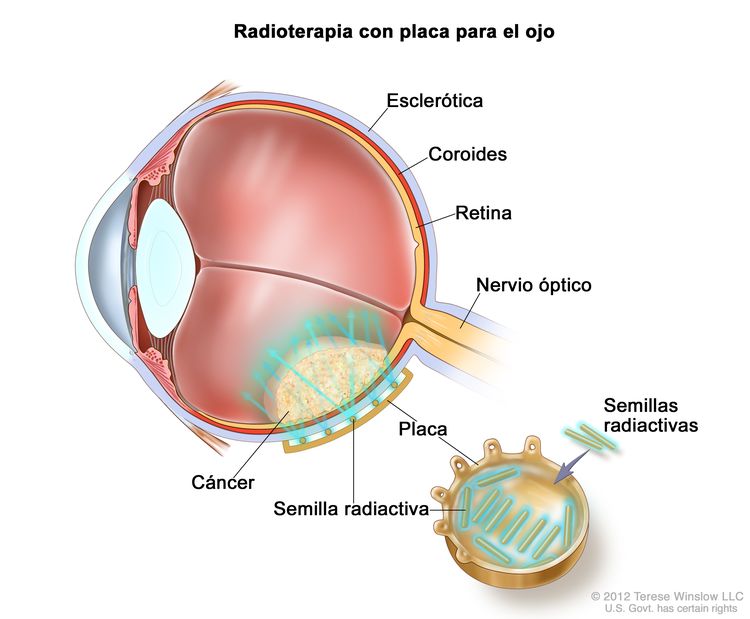 Dibujo de una sección transversal del ojo en el que se muestra la esclerótica, la coroides, la retina y el nervio óptico. También se observa un cáncer dentro del ojo y una placa radiactiva que se coloca en el exterior del ojo y emite rayos que atraviesan el cáncer. En una ampliación de la placa se observan semillas radiactivas en el interior.