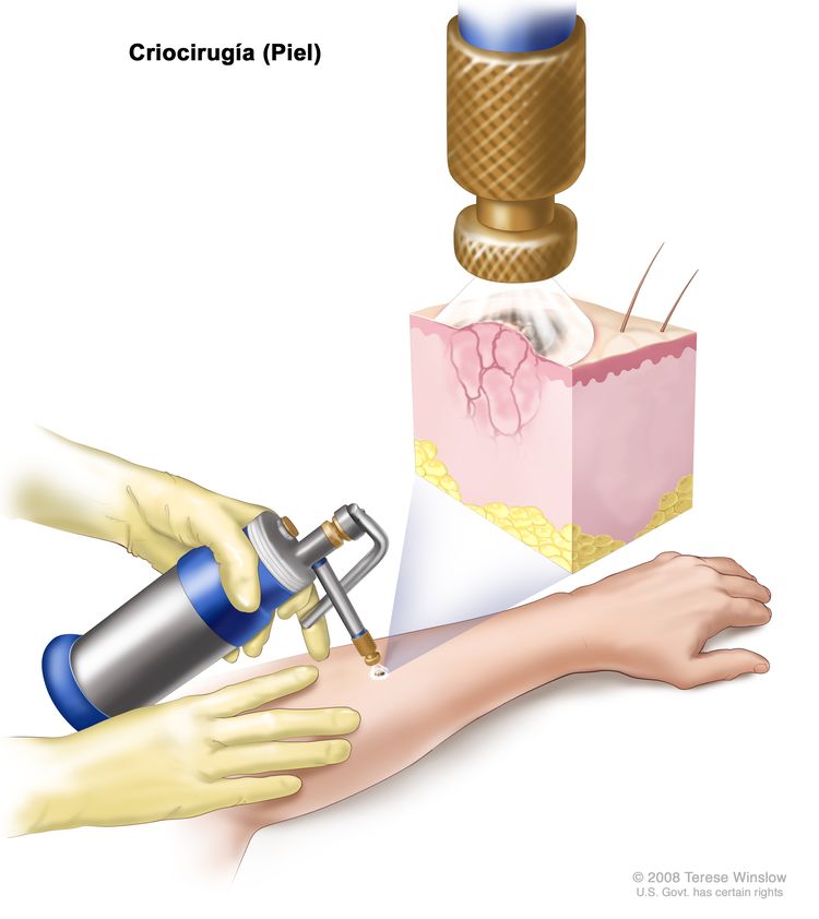 Criocirugía; el dibujo muestra un instrumento con una boquilla que se sostiene sobre un área anormal en la parte inferior del brazo de un paciente. El recuadro muestra una pulverización de nitrógeno líquido o de dióxido de carbono líquido que sale de la boquilla y cubre la lesión anormal. La congelación destruye la lesión.