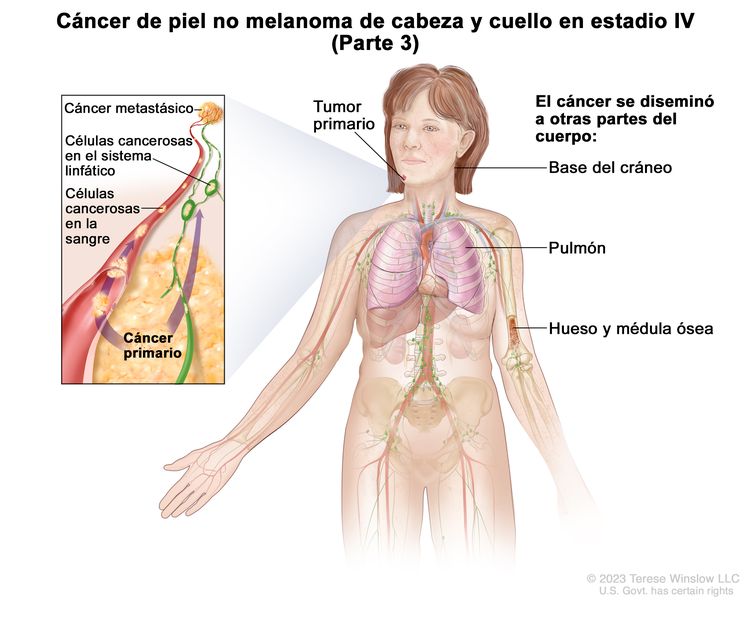 Cáncer de piel no melanoma de cabeza y cuello en estadio IV (Parte 3). En el dibujo se observa un tumor primario en la cara y otras partes del cuerpo donde es posible que el cáncer de piel no melanoma se disemine, como la base del cráneo, el pulmón, el hueso y la médula ósea. En el recuadro se muestran las células cancerosas que se diseminan a través de la sangre y el sistema linfático a otra parte del cuerpo donde se formó el cáncer metastásico.