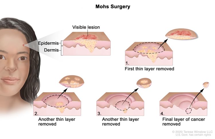 Mohs surgery; drawing shows a patient with skin cancer on the face. The pullout shows a block of skin with cancer in the epidermis (outer layer of the skin) and the dermis (inner layer of the skin). A visible lesion is shown on the skin’s surface. Four numbered blocks show the removal of thin layers of the skin one at a time until all the cancer is removed.