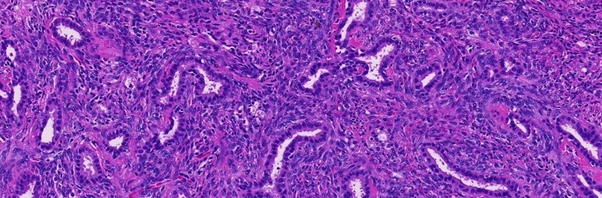 Pancreas tumor