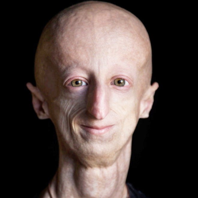 In Memory of PRF Ambassador and Progeria Researcher, Sammy Basso