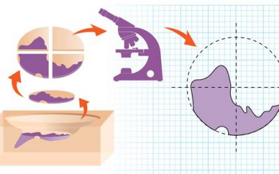 Mohs Surgery Graphic