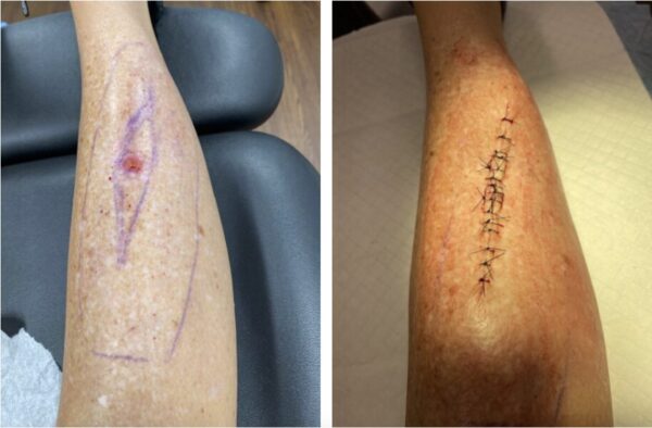 Melanoma before and after surgery. Photos: Melissa Garrett