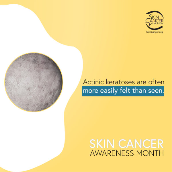 actinic keratoses are often more easily felt than seen