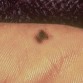 acral lentiginous melanoma