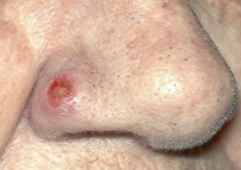 sebaceous carcinoma