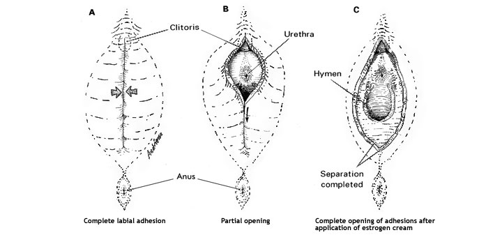 labial adhesions