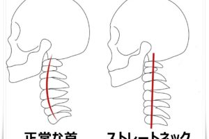 ストレートネック