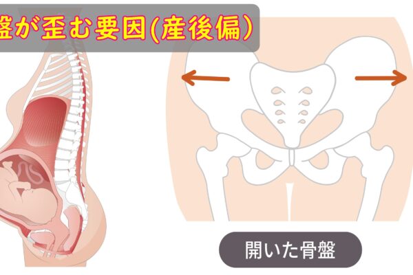 骨盤が歪む要因(産後偏)