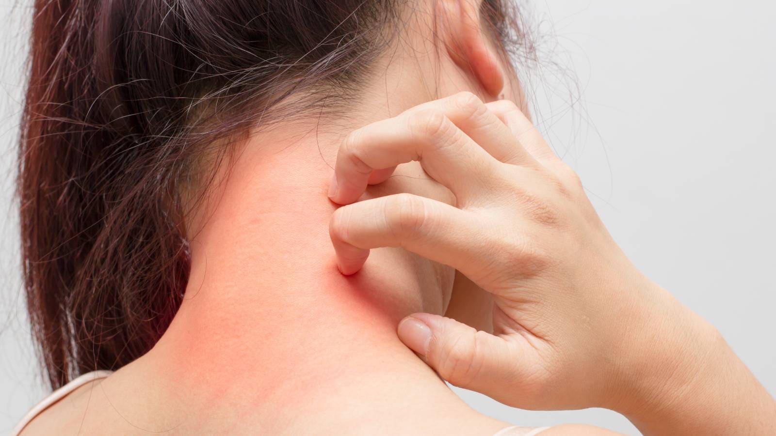skin allergy se kaise bachein