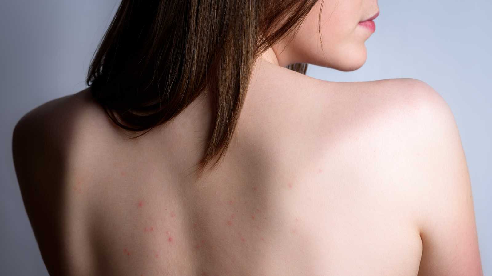 back acne