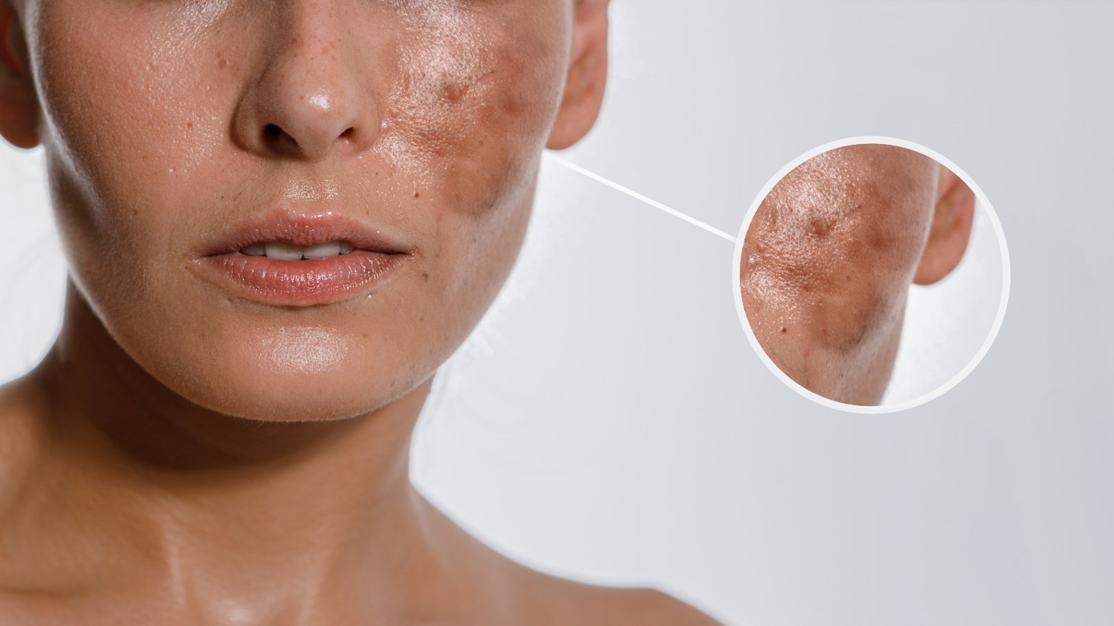 Laser therapy chehre par Hyperpigmentation ka upchar hai.