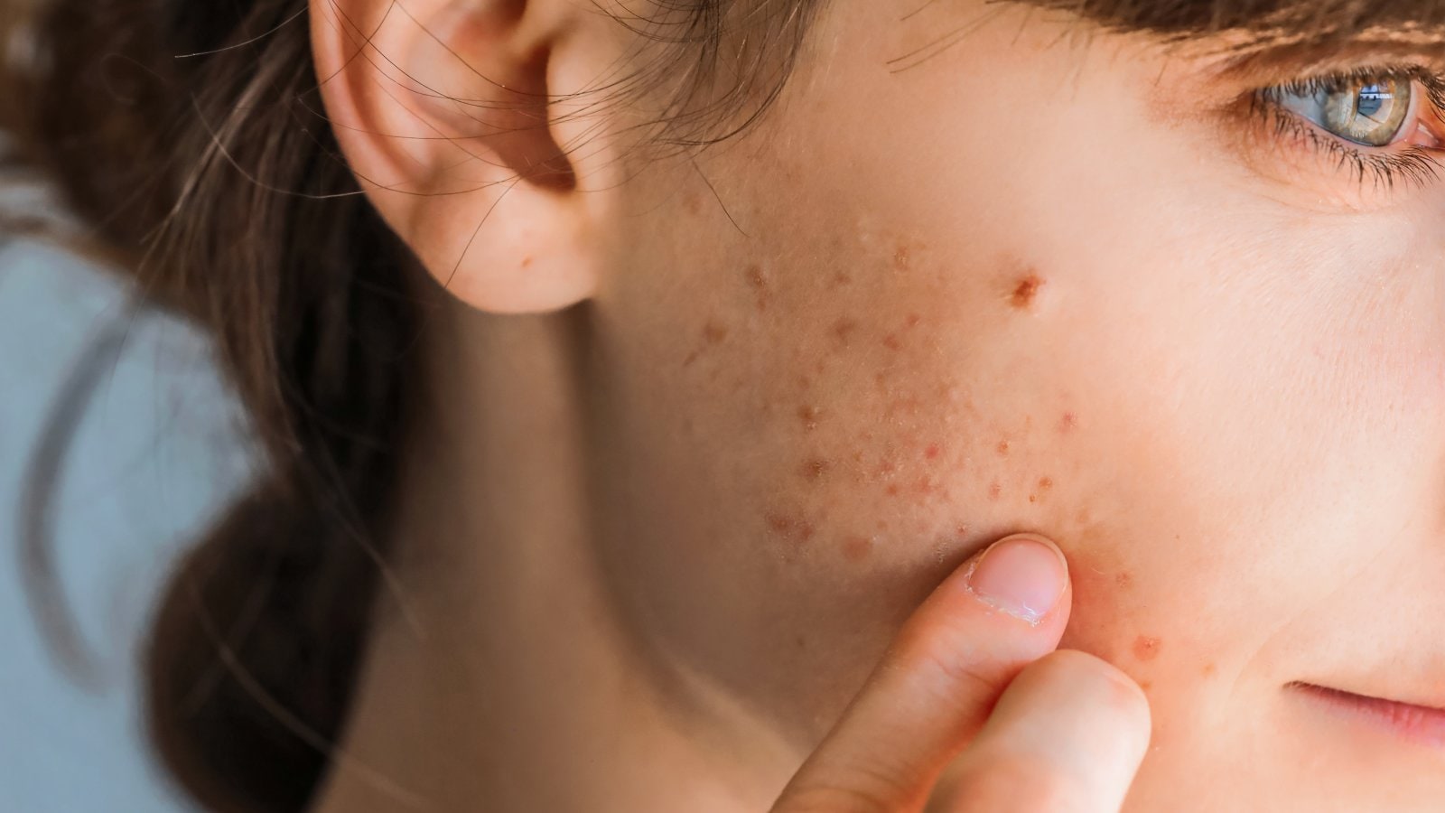 acne ka karan