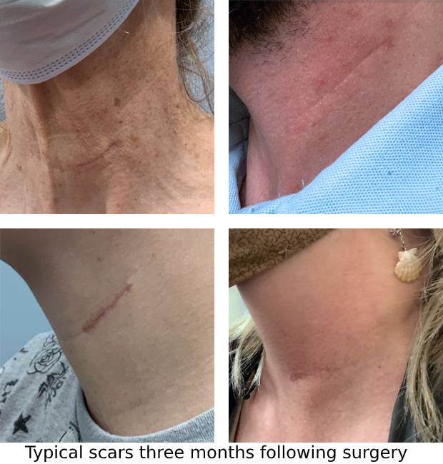 A collection of photos showing typical scars three months following surgery