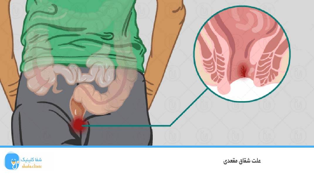 علت شقاق مقعدی
