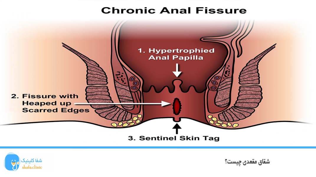 شقاق مقعدی چیست؟