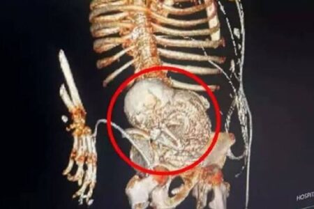 高齢女性の腹部に石灰化した胎児、56年間も体内にあった可能性【ブラジル】