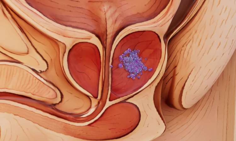 Prostate cancer conceptualisation