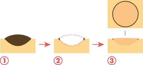ホクロ除去イメージ1